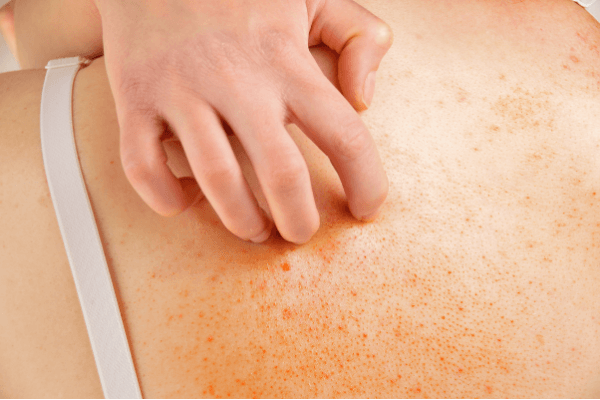 Body Gel For Itchy Skin