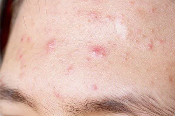 Facial Oil Blend For Acne-Prone Skin