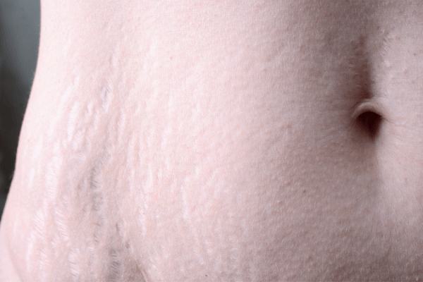 Stretch Mark Oil