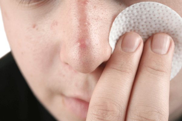 Daily Toner For Acne Prone Skin