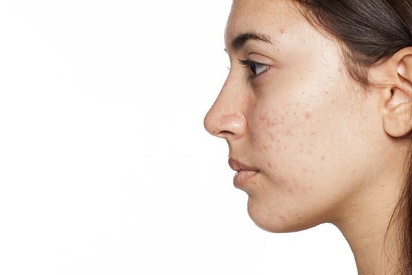 Facial Serum For Acne Prone Skin