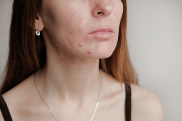 Oil For Combination Skin & Acne Prone Skin